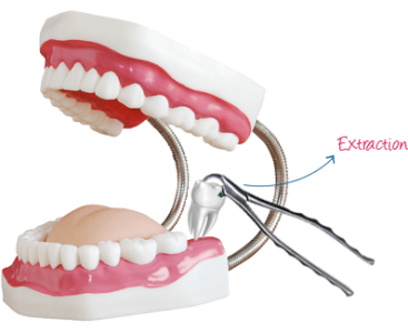 Dental Extractions